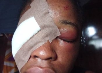 Four hundred level Student of IBBUL brutally attacked by her Ex-boy friend,damaged her eyes.