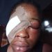 Four hundred level Student of IBBUL brutally attacked by her Ex-boy friend,damaged her eyes.