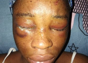 Four hundred level Student of IBBUL brutally attacked by her Ex-boy friend,damaged her eyes.