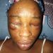 Four hundred level Student of IBBUL brutally attacked by her Ex-boy friend,damaged her eyes.